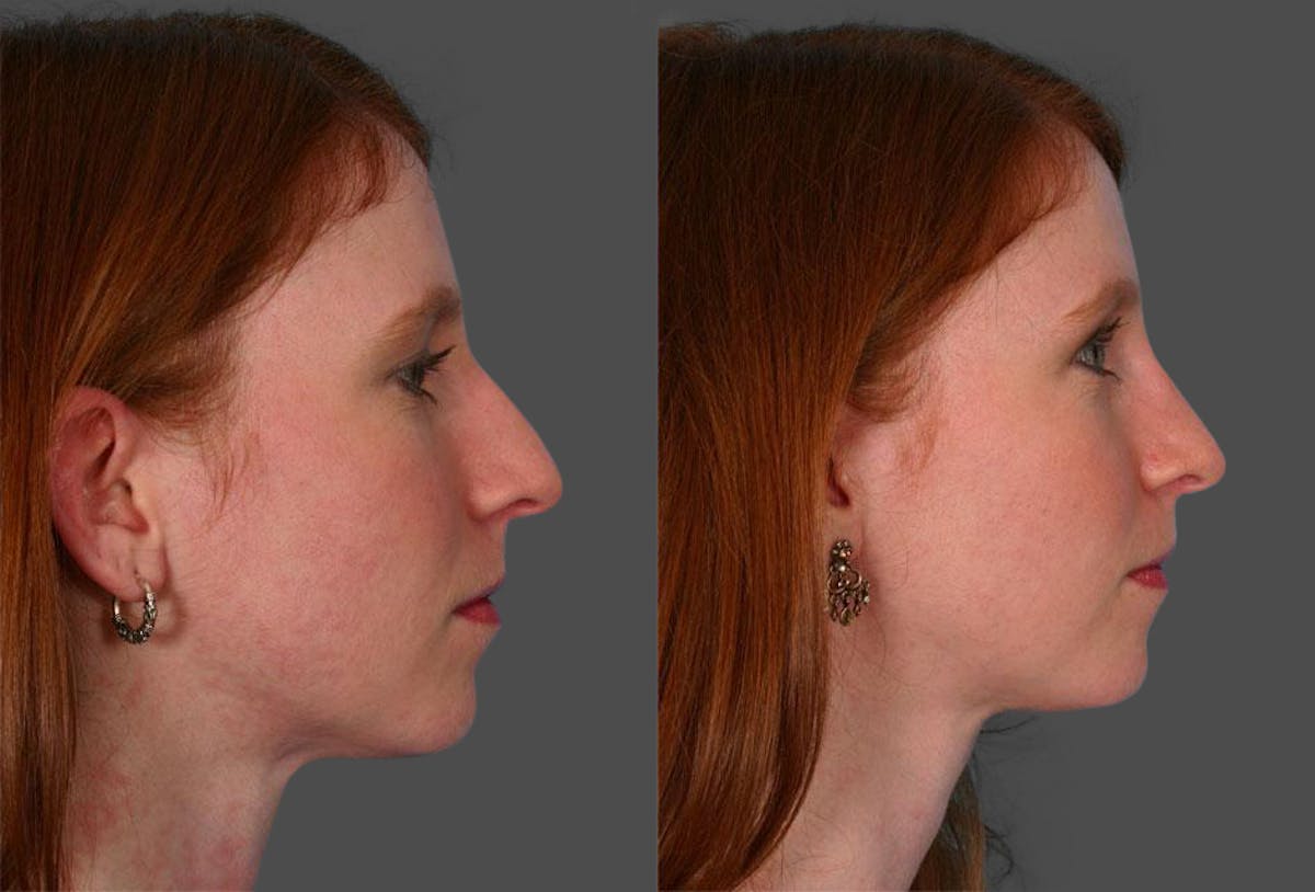Rhinoplasty Before & After Gallery - Patient 100922 - Image 2
