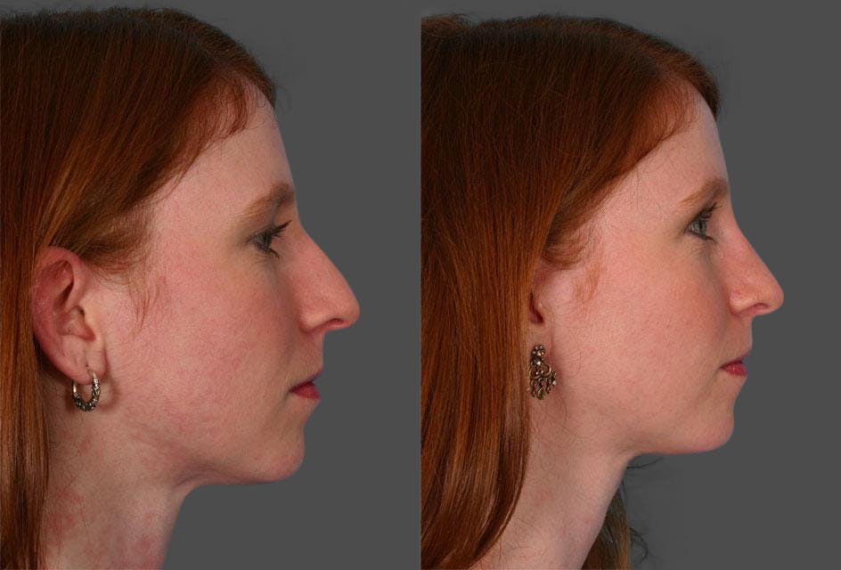 Rhinoplasty Before & After Gallery - Patient 100922 - Image 2
