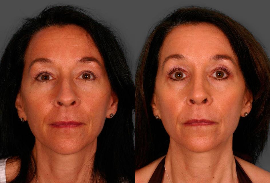 Rhinoplasty Before & After Gallery - Patient 125832 - Image 1