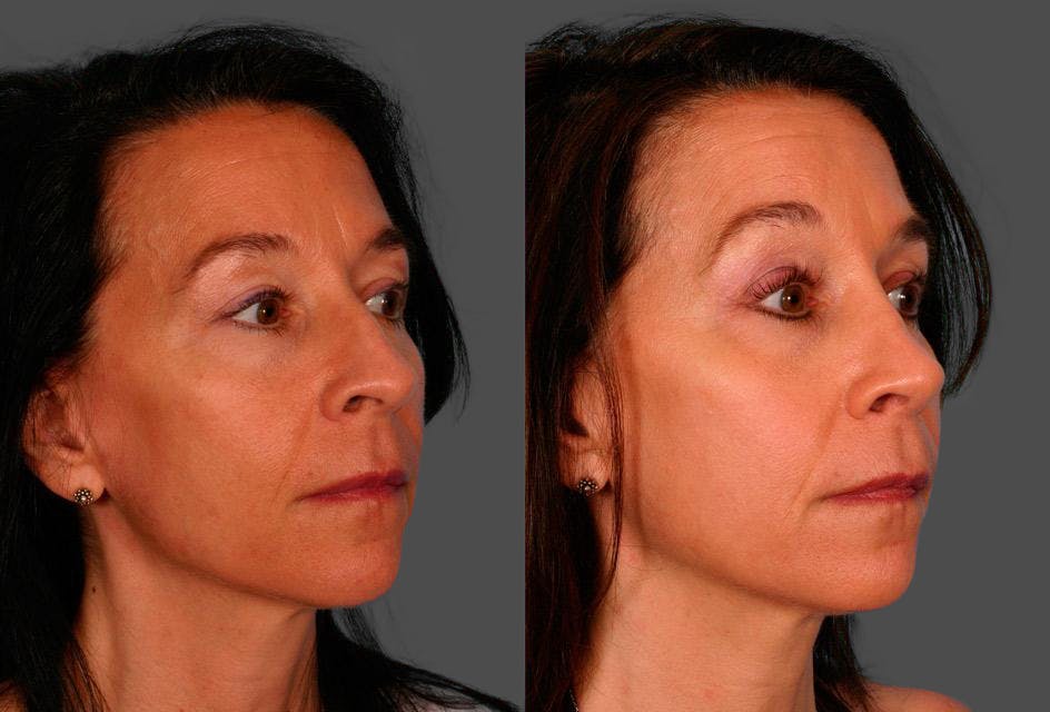 Rhinoplasty Before & After Gallery - Patient 125832 - Image 2