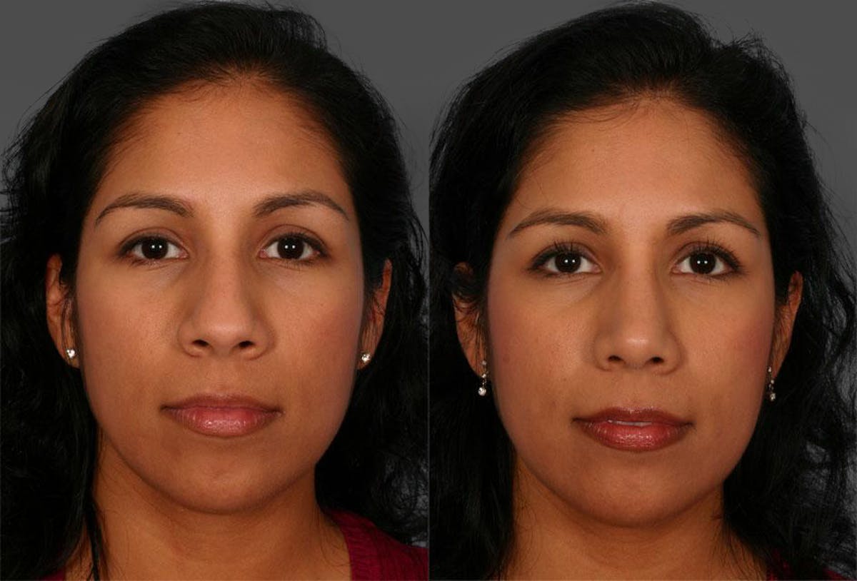 Rhinoplasty Before & After Gallery - Patient 141314 - Image 1