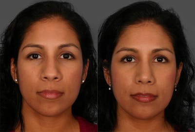 Rhinoplasty Before & After Gallery - Patient 141314 - Image 1