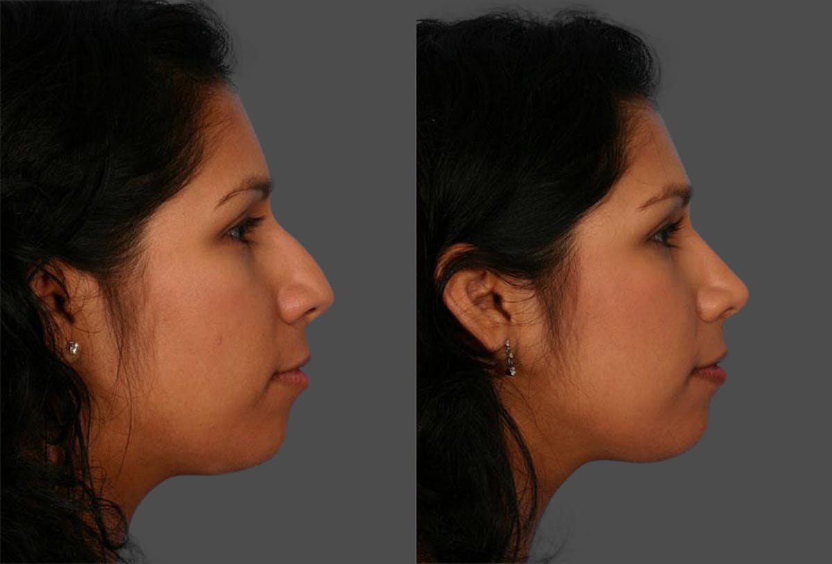 Rhinoplasty Before & After Gallery - Patient 141314 - Image 2