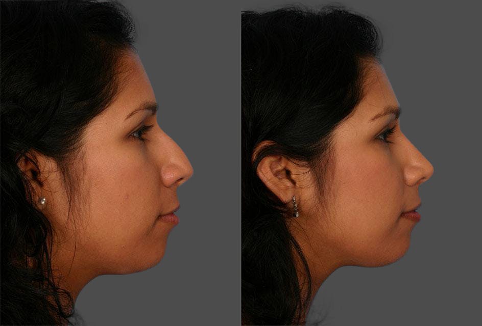 Rhinoplasty Before & After Gallery - Patient 141314 - Image 2