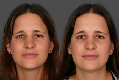 Rhinoplasty Before & After Gallery - Patient 148504 - Image 1