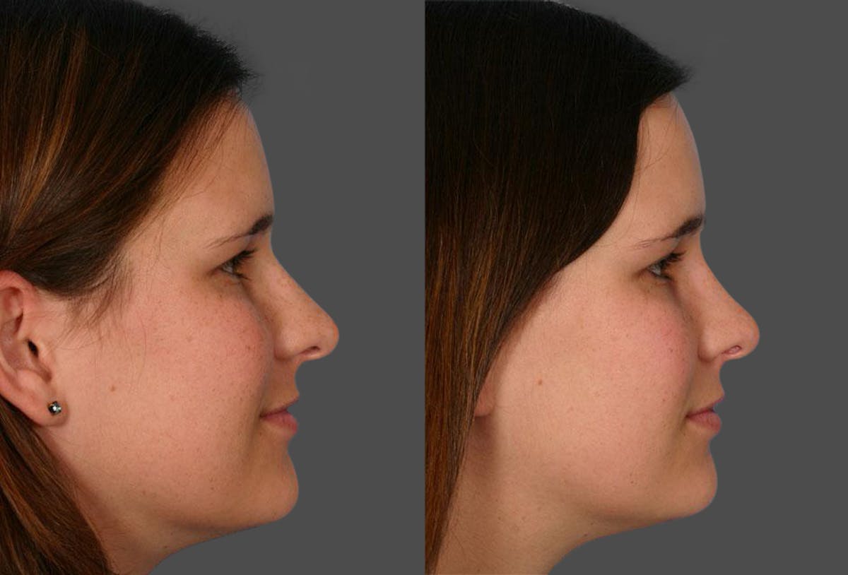 Rhinoplasty Before & After Gallery - Patient 148504 - Image 2