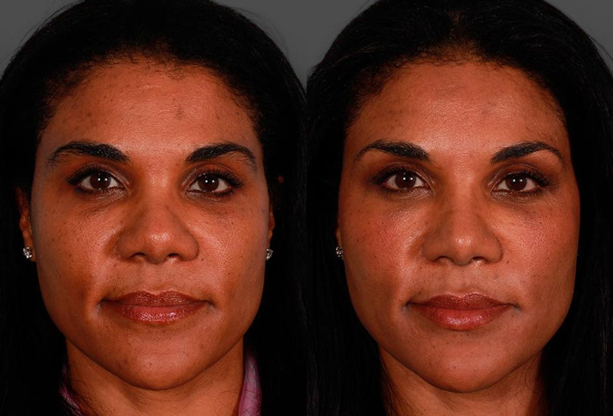 Rhinoplasty Before & After Gallery - Patient 174698 - Image 1