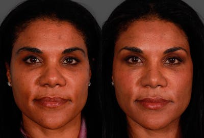 Rhinoplasty Before & After Gallery - Patient 174698 - Image 1