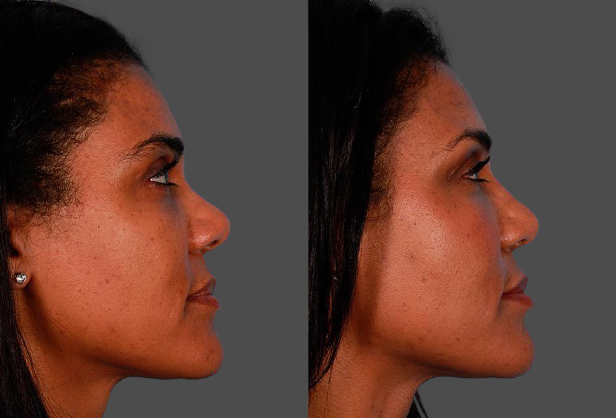 Rhinoplasty Before & After Gallery - Patient 174698 - Image 2