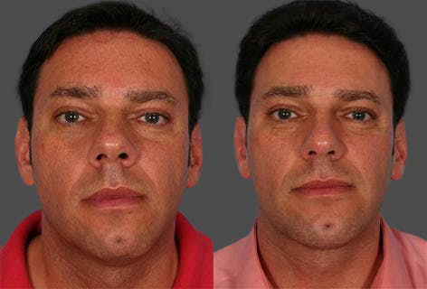Rhinoplasty Before & After Gallery - Patient 185242 - Image 1