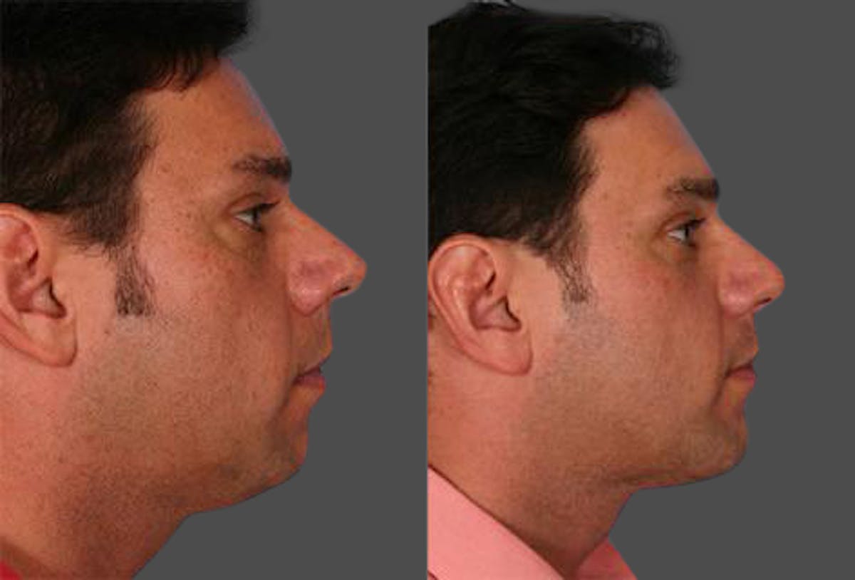 Rhinoplasty Before & After Gallery - Patient 185242 - Image 2