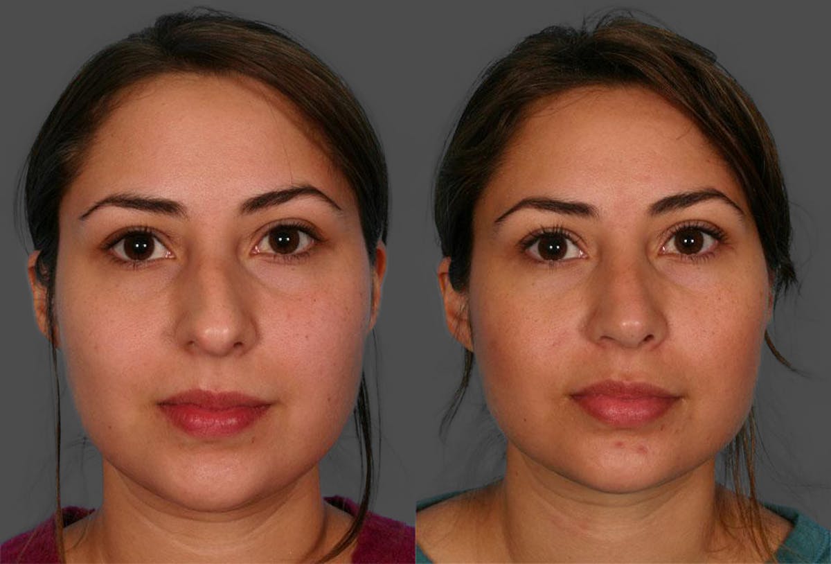 Rhinoplasty Before & After Gallery - Patient 206176 - Image 2