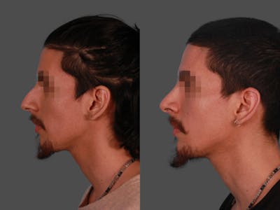 Rhinoplasty Before & After Gallery - Patient 230635 - Image 1