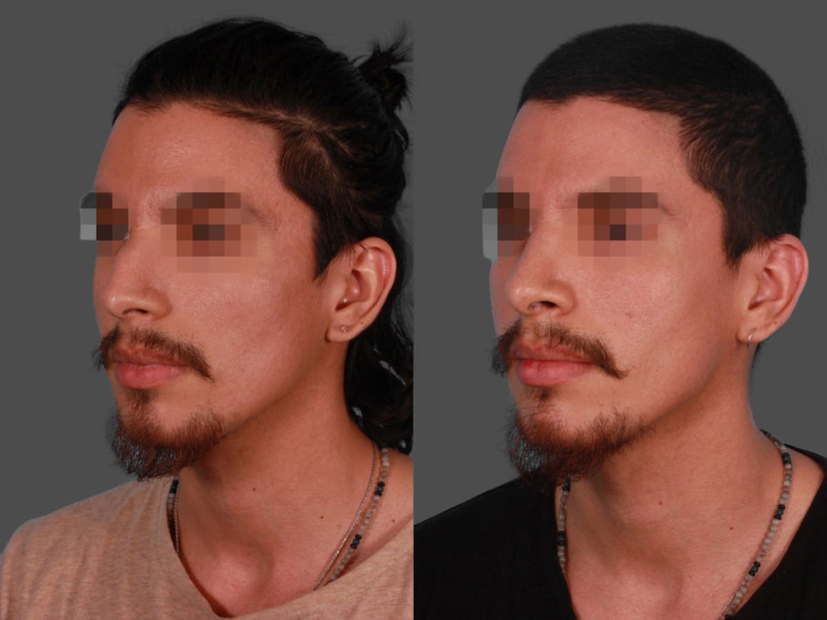 Rhinoplasty Before & After Gallery - Patient 230635 - Image 2