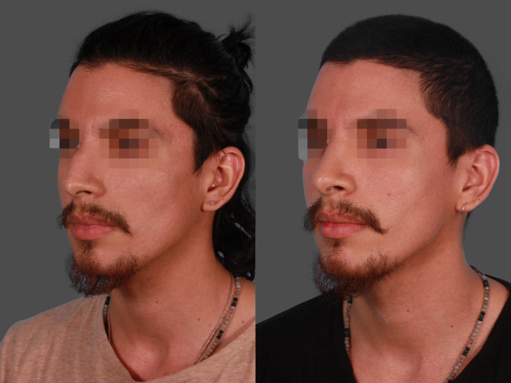 Rhinoplasty Before & After Gallery - Patient 230635 - Image 2