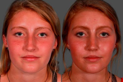 Rhinoplasty Before & After Gallery - Patient 231749 - Image 1