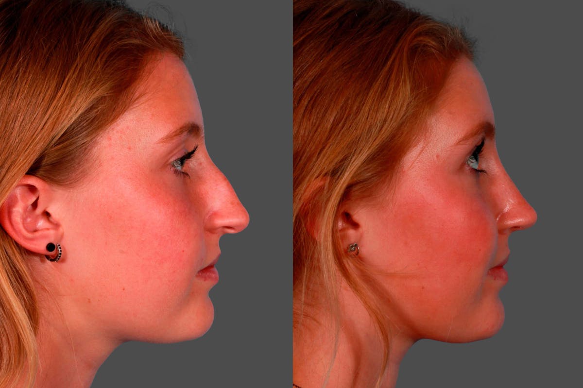 Rhinoplasty Before & After Gallery - Patient 231749 - Image 2