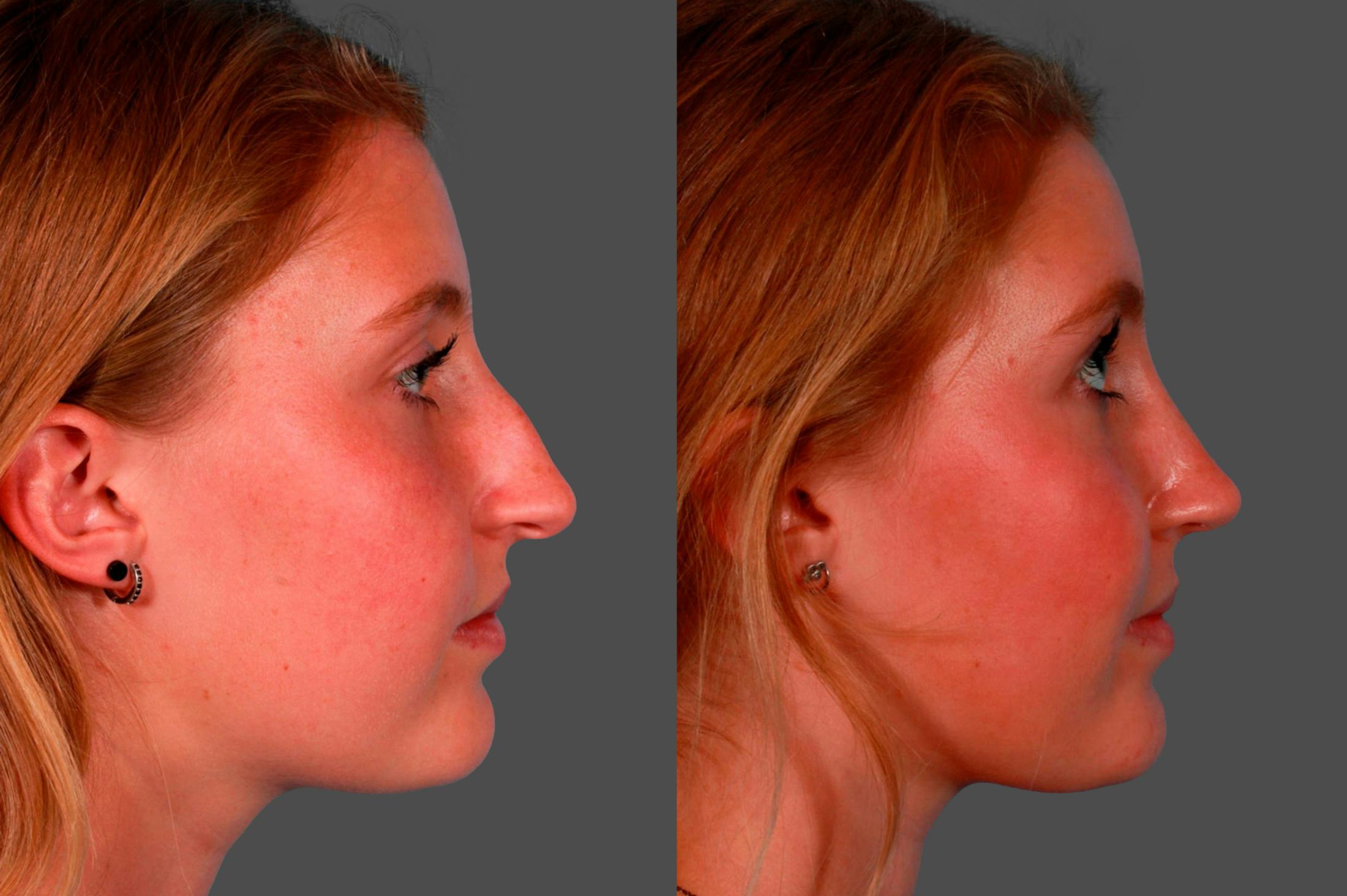 Rhinoplasty Before & After Gallery - Patient 231749 - Image 2