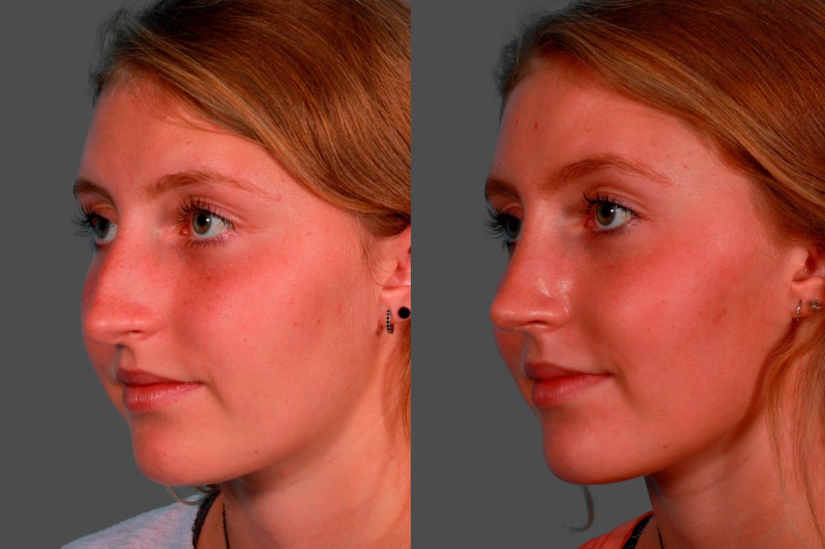 Rhinoplasty Before & After Gallery - Patient 231749 - Image 3