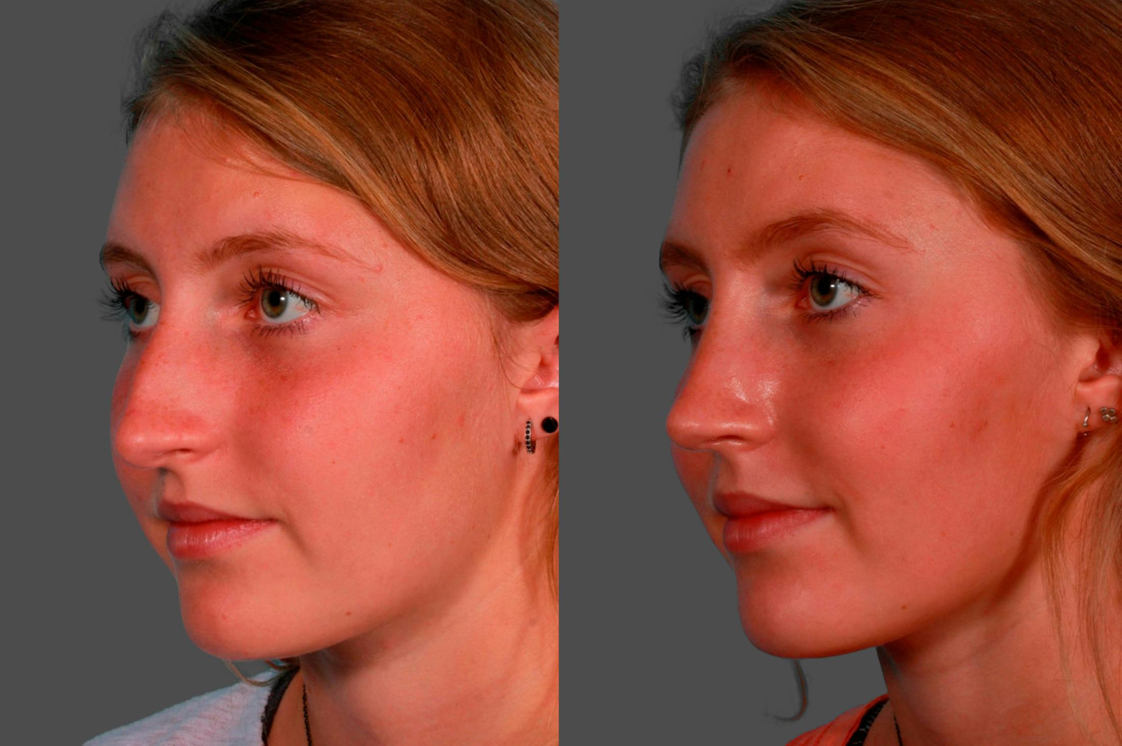 Rhinoplasty Before & After Gallery - Patient 231749 - Image 3