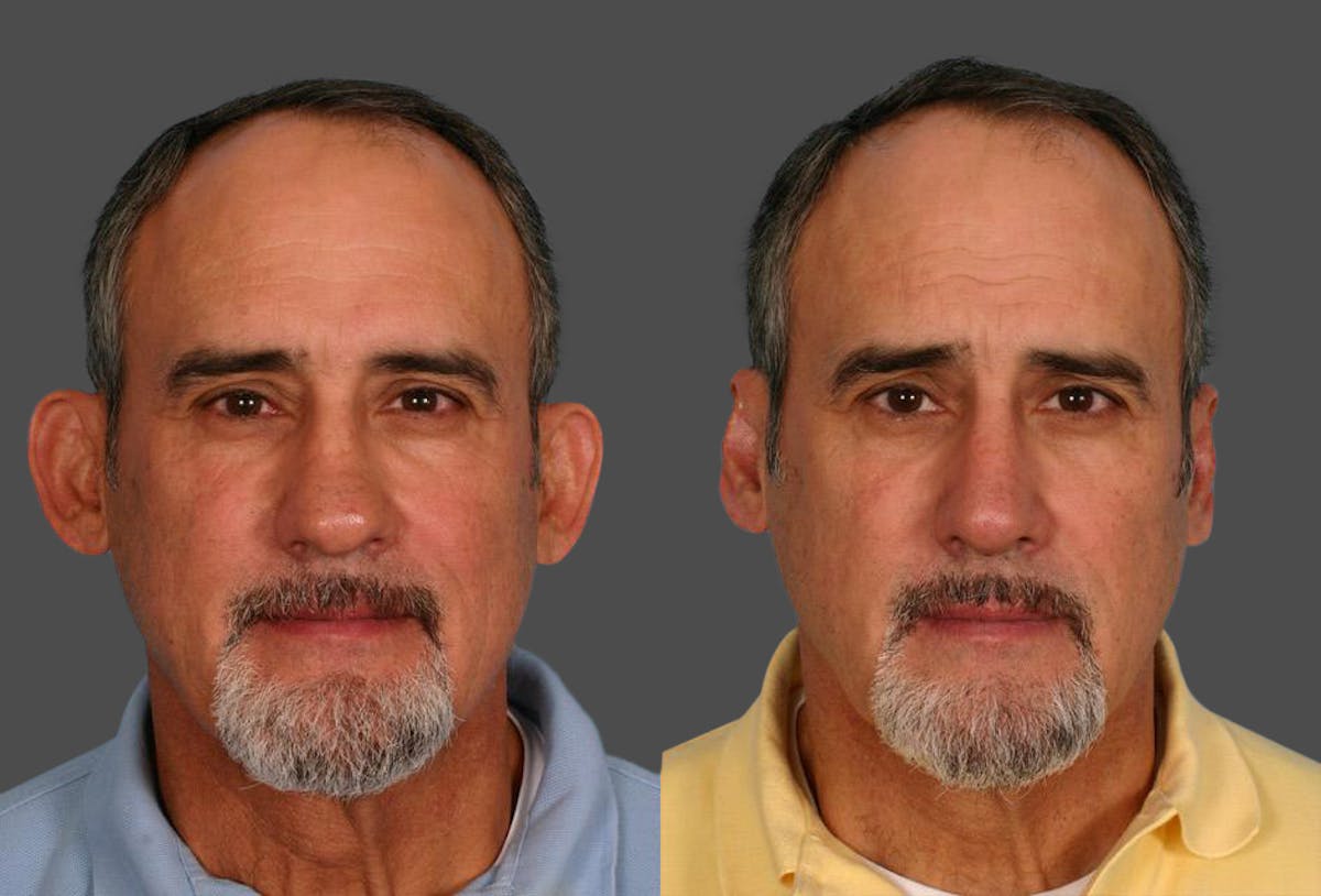 Rhinoplasty Before & After Gallery - Patient 244130 - Image 1