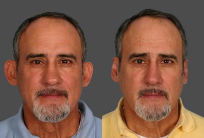 Rhinoplasty Before & After Gallery - Patient 244130 - Image 1