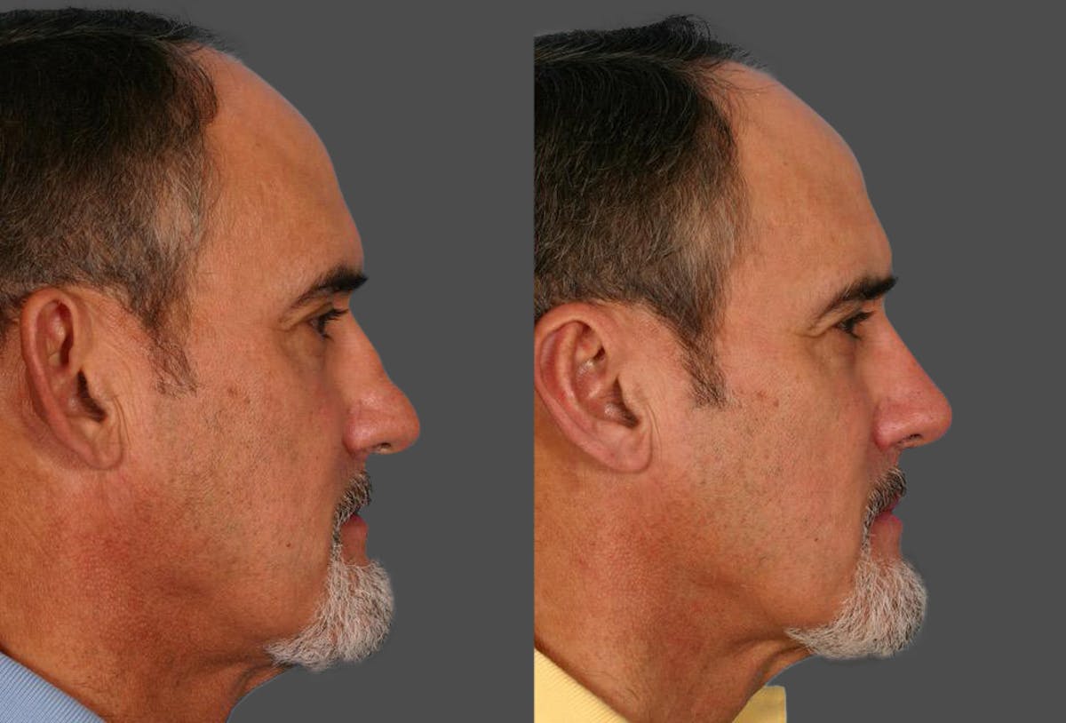 Rhinoplasty Before & After Gallery - Patient 244130 - Image 2