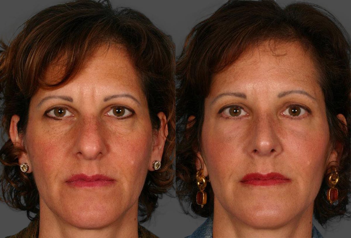 Rhinoplasty Before & After Gallery - Patient 264599 - Image 1