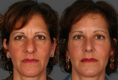 Rhinoplasty Before & After Gallery - Patient 264599 - Image 1