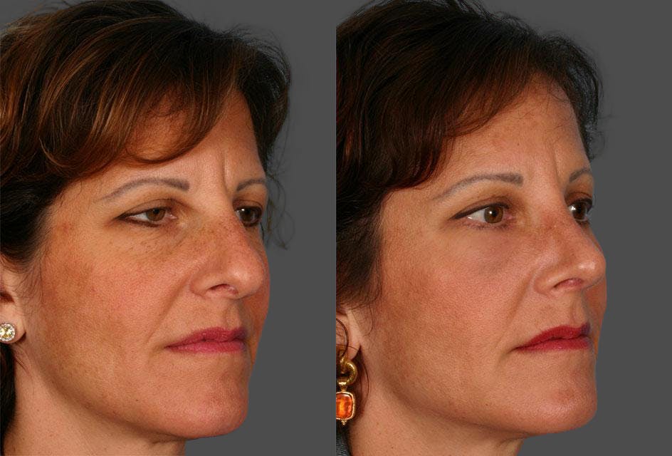Rhinoplasty Before & After Gallery - Patient 264599 - Image 2