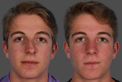 Rhinoplasty Before & After Gallery - Patient 273172 - Image 1