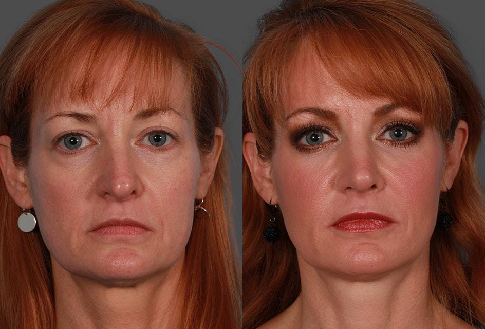 JUVEDERM® Before & After Gallery - Patient 510522 - Image 1