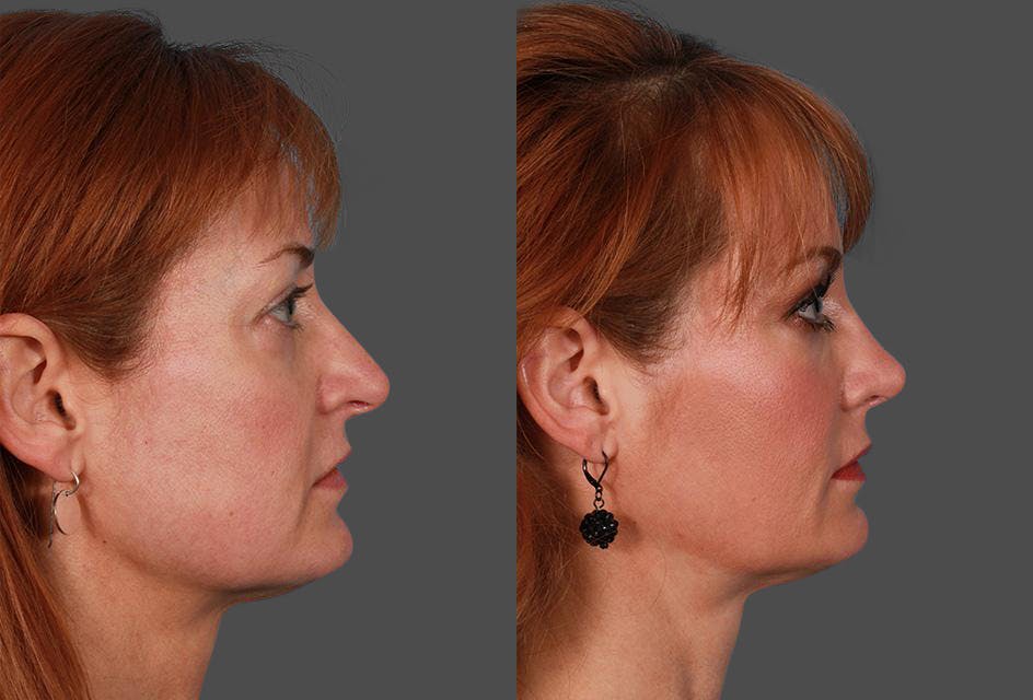 JUVEDERM® Before & After Gallery - Patient 510522 - Image 2