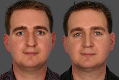 Rhinoplasty Before & After Gallery - Patient 284627 - Image 1