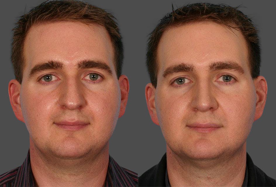 Rhinoplasty Before & After Gallery - Patient 284627 - Image 1