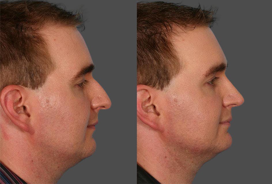 Rhinoplasty Before & After Gallery - Patient 284627 - Image 2