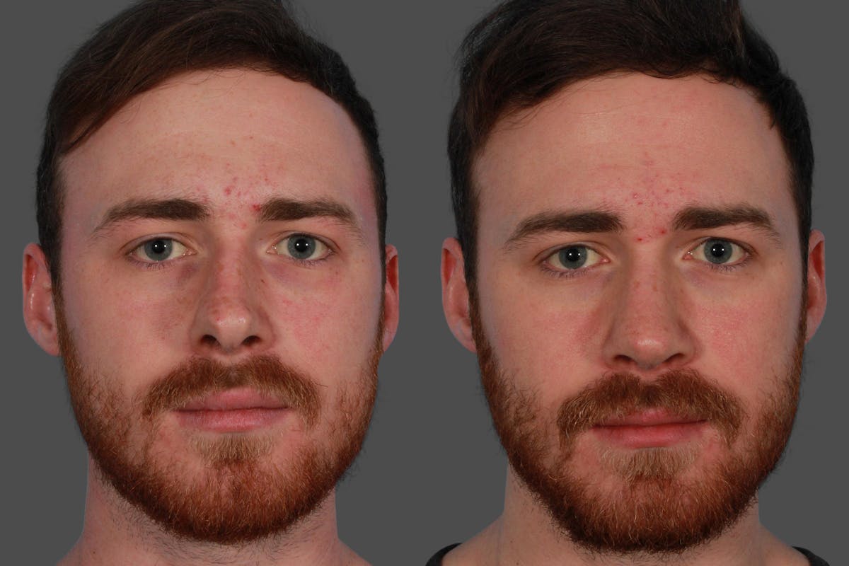 Rhinoplasty Before & After Gallery - Patient 292929 - Image 1