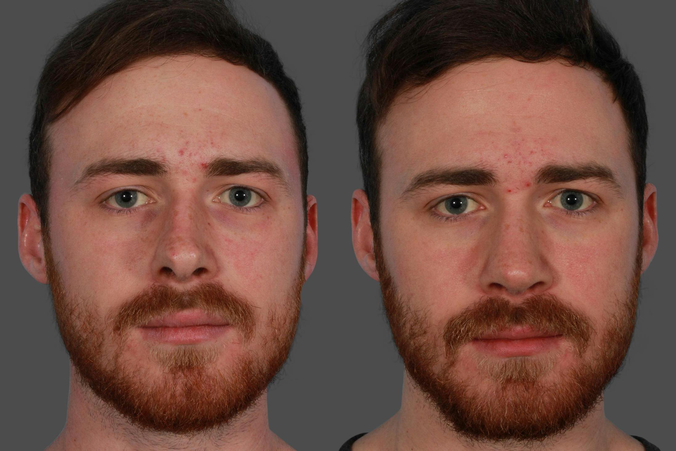 Rhinoplasty Before & After Gallery - Patient 292929 - Image 1