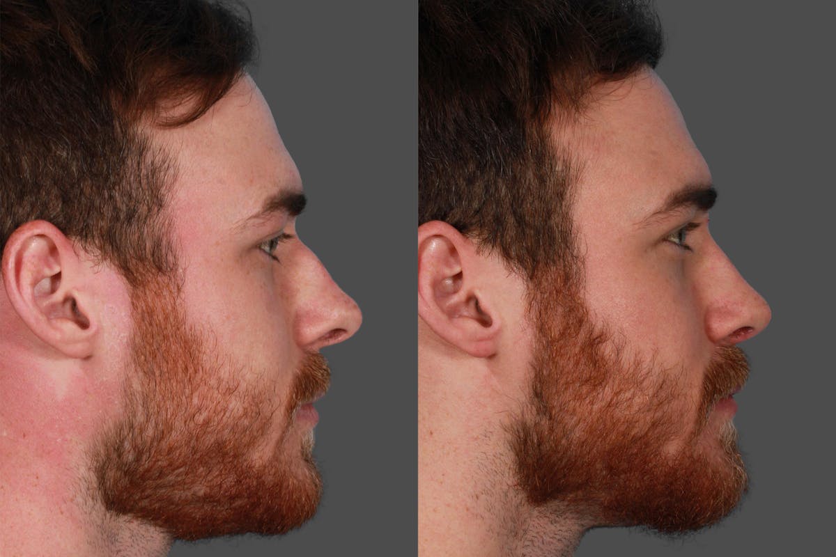 Rhinoplasty Before & After Gallery - Patient 292929 - Image 2