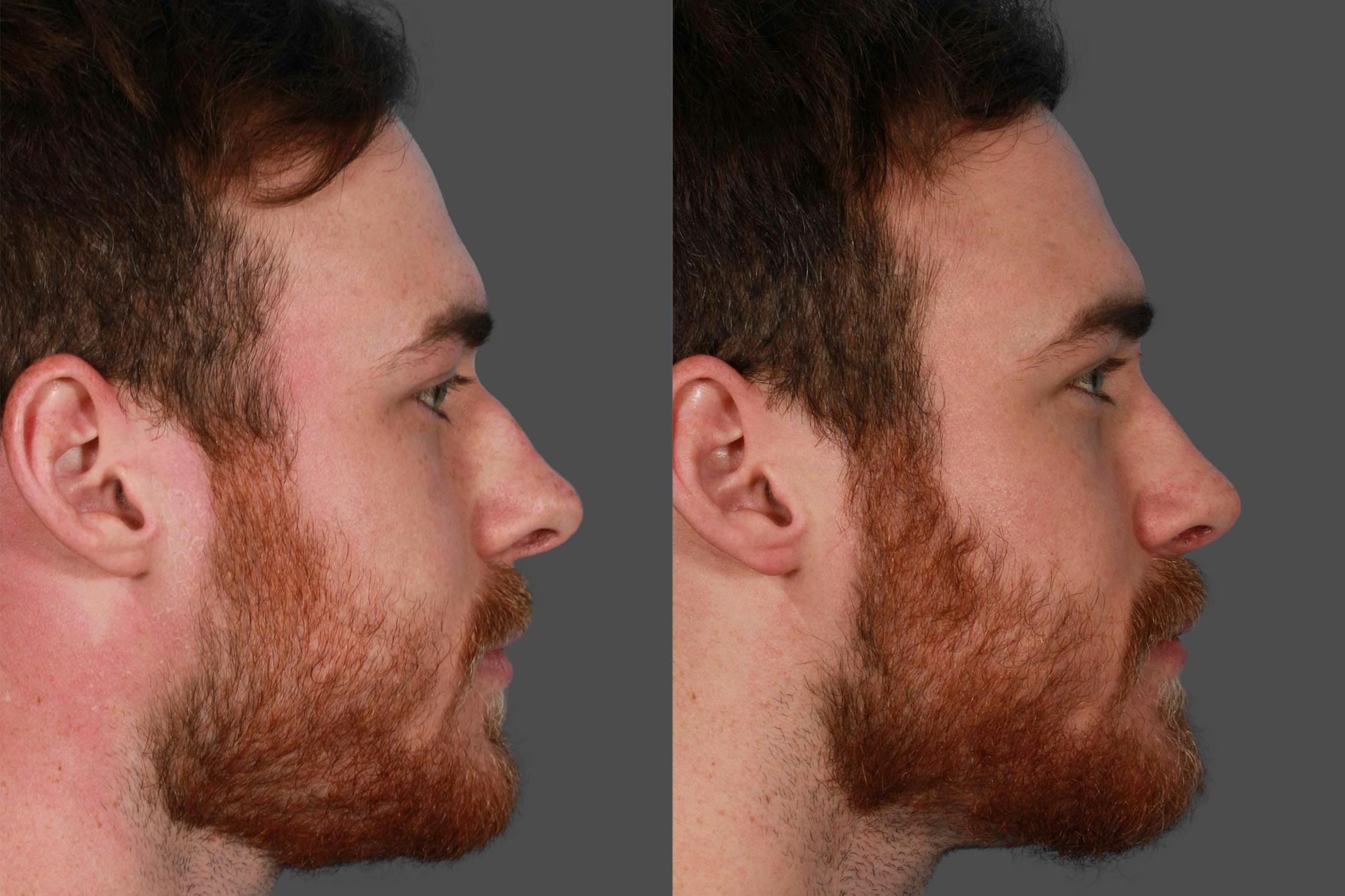 Rhinoplasty Before & After Gallery - Patient 292929 - Image 2