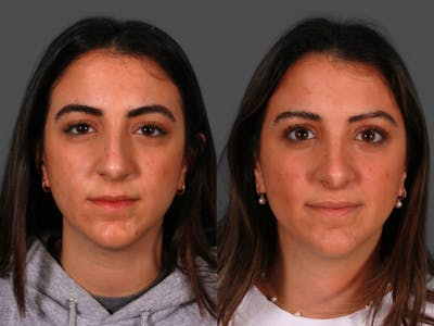 Rhinoplasty Before & After Gallery - Patient 297327 - Image 1