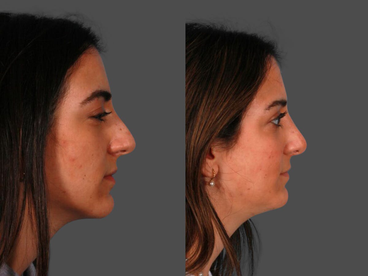 Rhinoplasty Before & After Gallery - Patient 297327 - Image 2