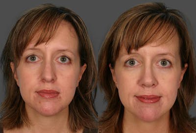 Rhinoplasty Before & After Gallery - Patient 322529 - Image 1