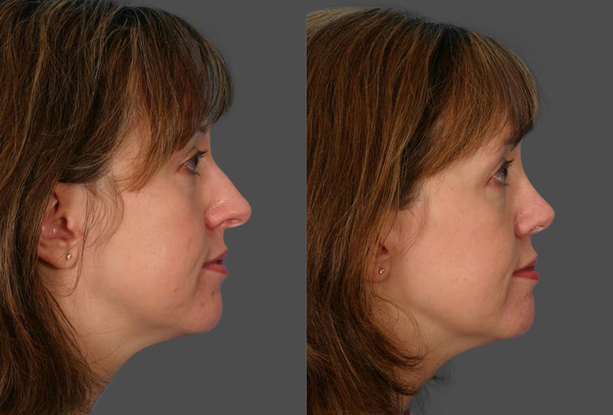 Rhinoplasty Before & After Gallery - Patient 322529 - Image 2