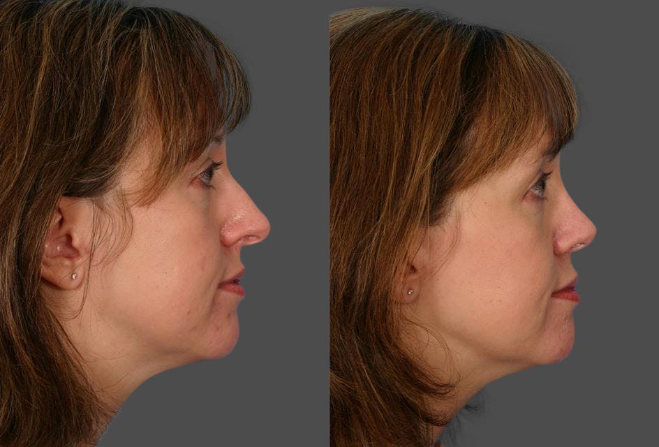 Rhinoplasty Before & After Gallery - Patient 322529 - Image 2