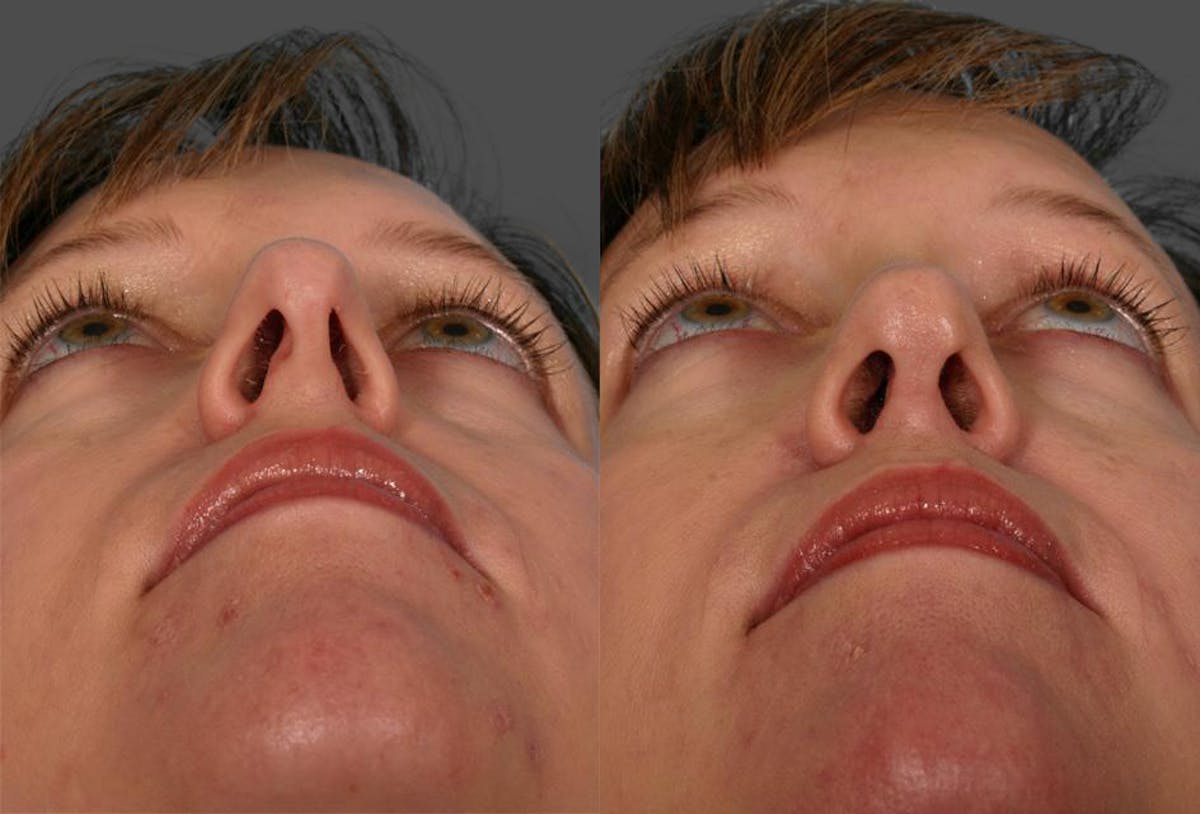 Rhinoplasty Before & After Gallery - Patient 322529 - Image 3
