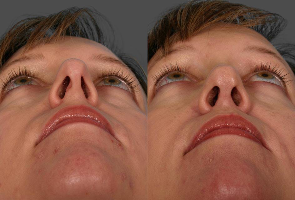 Rhinoplasty Before & After Gallery - Patient 322529 - Image 3