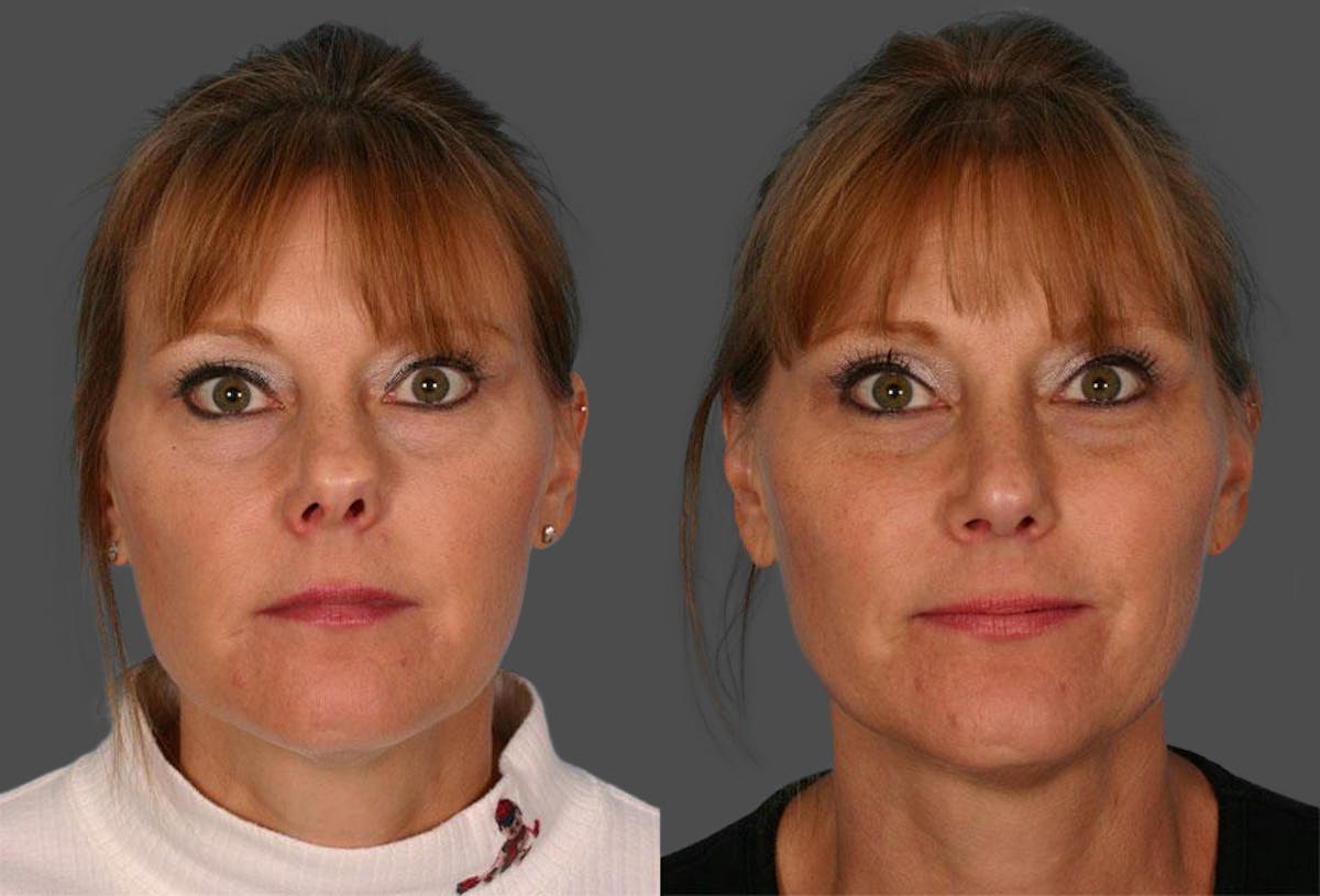 Rhinoplasty Before & After Gallery - Patient 348968 - Image 1