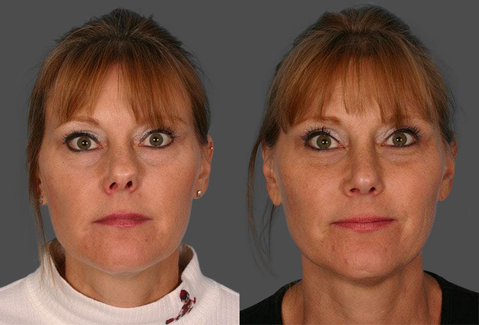 Rhinoplasty Before & After Gallery - Patient 348968 - Image 1
