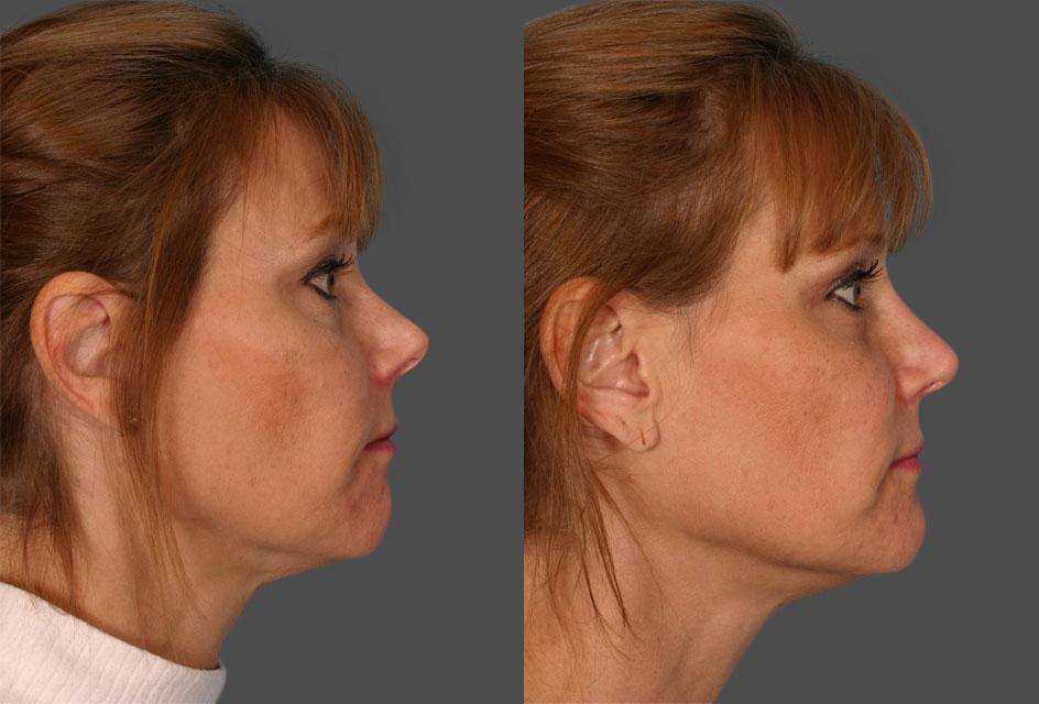 Rhinoplasty Before & After Gallery - Patient 348968 - Image 2
